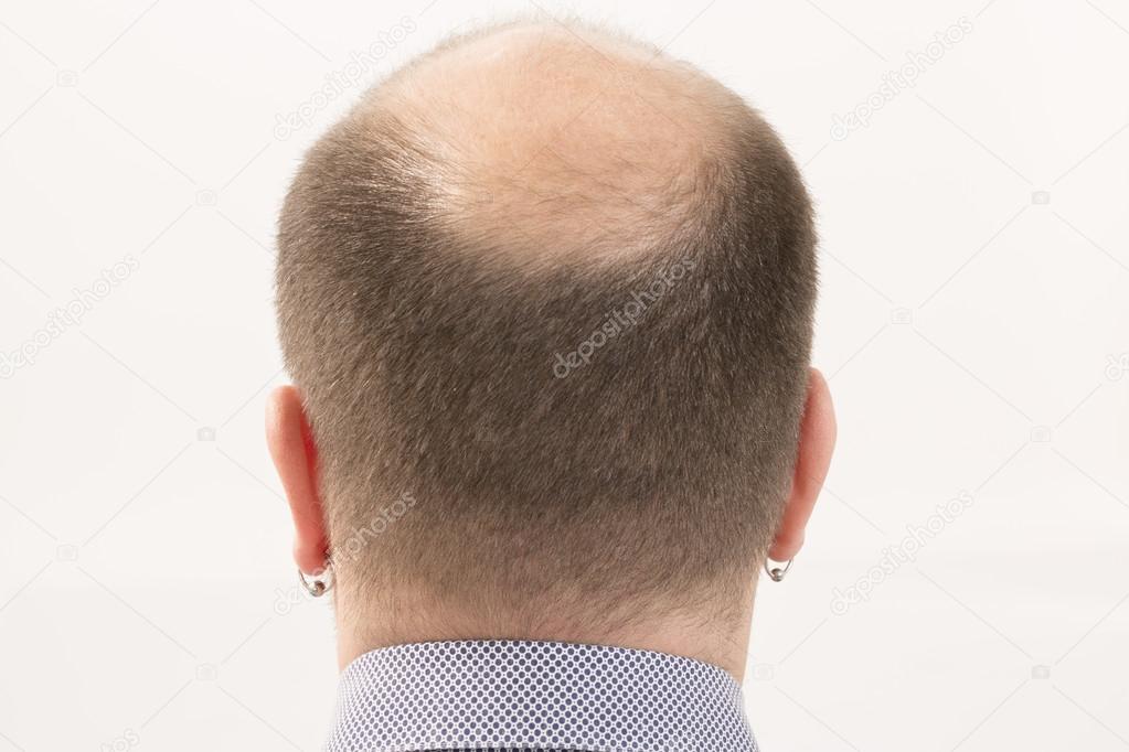 Premature baldness, man, 40s, white background