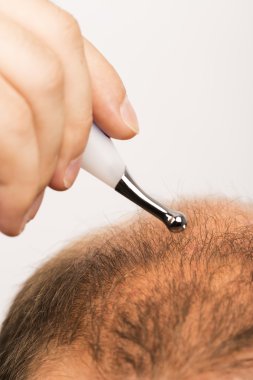 Erken kellik, erkek, 40 yaşlarında, beyaz arka plan