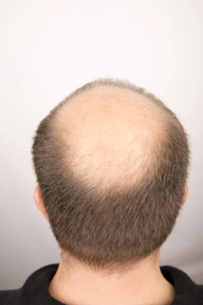 Человек контролирует выпадение волос — стоковое фото