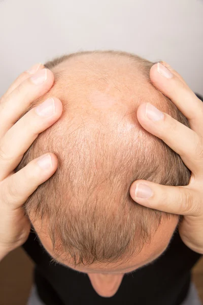 Mann kontrolliert Haarausfall — Stockfoto