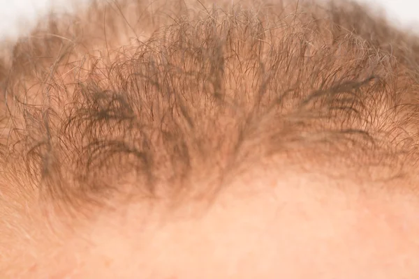 Homme contrôle la perte de cheveux — Photo