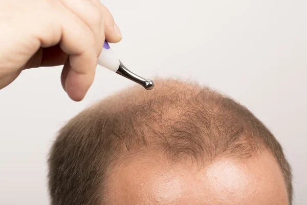 man controls hair loss