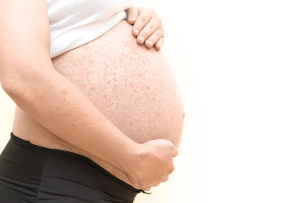 Allergy on pregnant belly — Stock Photo, Image
