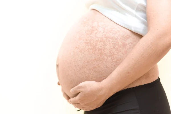 Alergia na barriga grávida — Fotografia de Stock