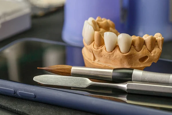 Impianto Dentale Restauro Dei Denti Chirurgo Dentale Laboratorio Dentistico Clinica — Foto Stock