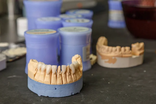 Dental implant. Restoration of teeth. Dental surgeon. Dental laboratory. Dental clinic. Implants of the jaw of a person. Visual materials at the dentist\'s office. Oral health.