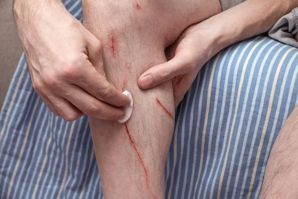 Hombre Trata Sus Zarapinos Con Hisopo Algodón Antiséptico Heridas Frescas — Foto de Stock