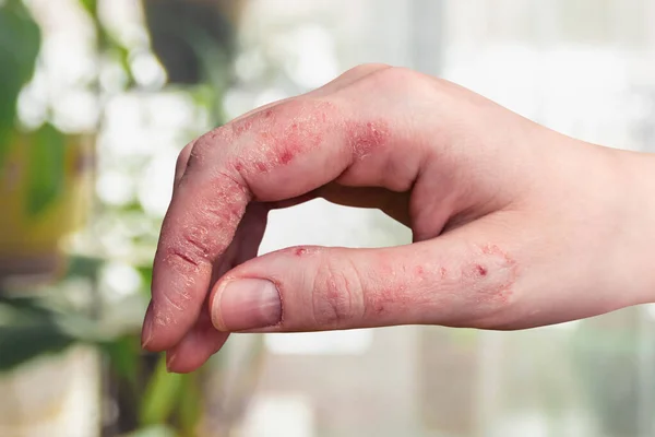 Psoriasis Piel Mano Una Mujer Peeling Erupciones Grietas Piel Del — Foto de Stock