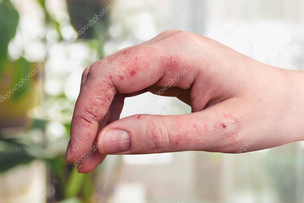 Psoriasis of the skin on a woman's hand. Peeling, rashes and cracks in the patient's skin. Chronic dermatological disease. Hand problem from too much moisture.