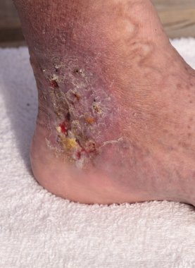 Tıbbi resim: enfeksiyon selülit bir ayak bileği cilt üzerinde