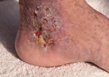 Tıbbi resim: enfeksiyon selülit bir ayak bileği cilt üzerinde