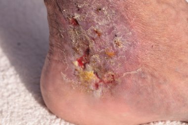 Tıbbi resim: enfeksiyon selülit bir ayak bileği cilt üzerinde