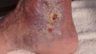 Tıbbi resim: enfeksiyon selülit bir ayak bileği cilt üzerinde