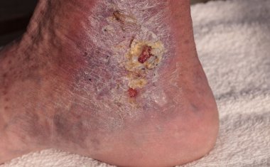 Tıbbi resim: enfeksiyon selülit bir ayak bileği cilt üzerinde