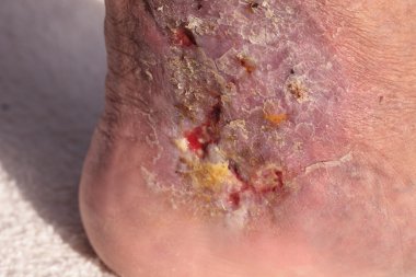 Tıbbi resim: enfeksiyon selülit bir ayak bileği cilt üzerinde