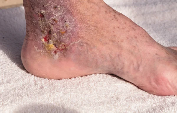 Medische foto: infectie cellulitis op de huid van een enkel — Stockfoto