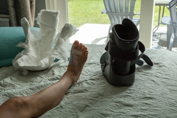 Cast removed from a foot after bunion surgery as the leg is elevated and resting.