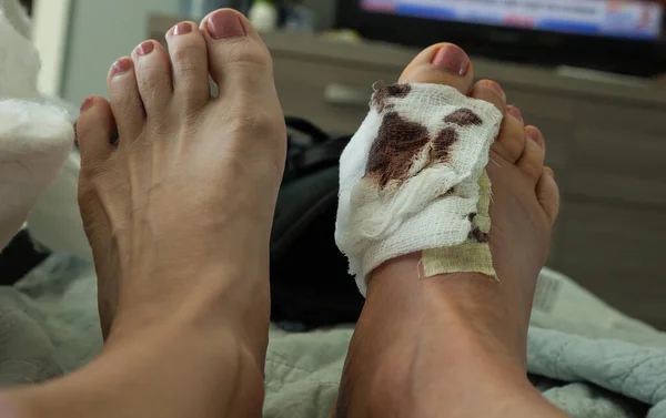 Bloody bandages on a foot with stiches after a bunion surgery as a foot is elevated and resting.