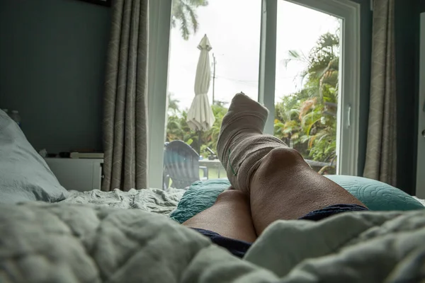 Foot in a cast after the first week of bunion foot surgery during recovery.