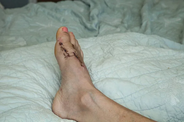 Швы Удалены Нога Поднята После Операции Мозоли Кровати Стоковое Фото