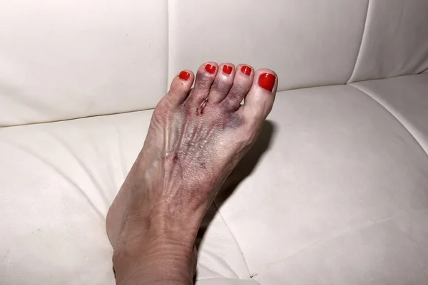 Voet na Mortons neuroma chirurgie — Stockfoto