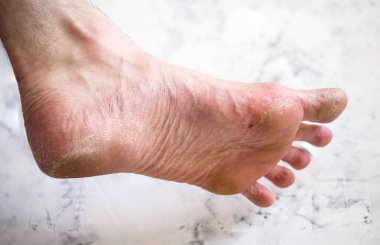 Adamın bacağındaki hastalık. Kuru ayak..