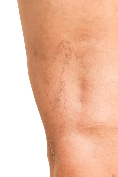 Varices sur les jambes des femmes d'âge moyen . — Photo