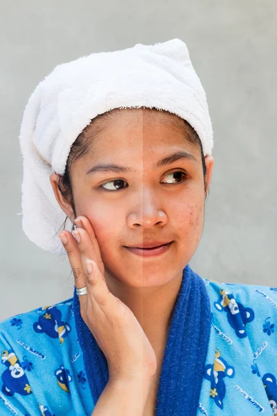 Vor und nach kosmetischen Operationen, Entfernung der Akne auf dem grauen Rücken — Stockfoto