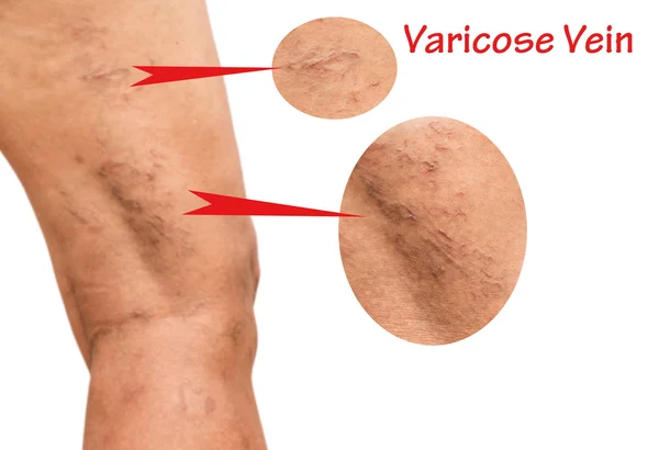 Varicose veins on the legs of middle-aged women. — Stock Photo, Image