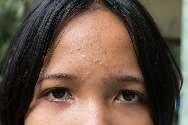 Акне на коже лица подростка — стоковое фото