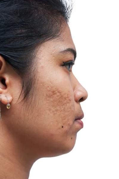 Akne auf der Haut Gesicht Frauen — Stockfoto