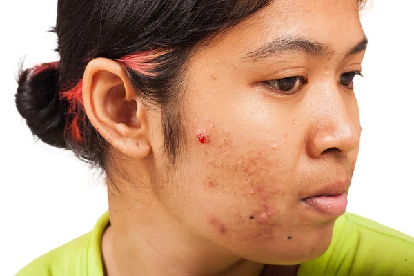 Acne på ansigt teennager pige - Stock-foto