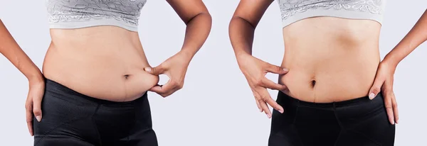 Kvinnor kropp tjock mage mellan före och efter viktminskning — Stockfoto