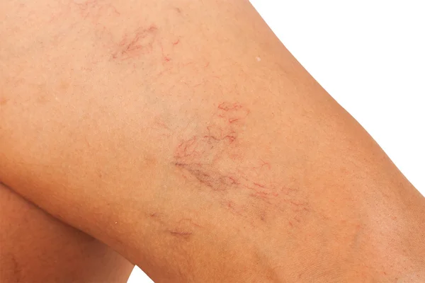 Varicose veins on the legs of middle-aged women. — Stock Photo, Image