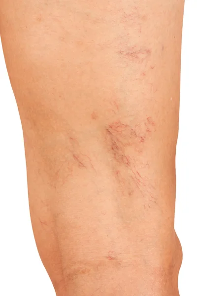 Åderbråck på benen av medelålders kvinnor. — Stockfoto