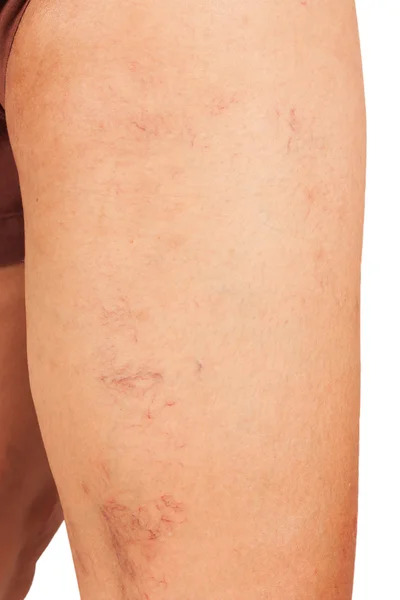 Venas varicosas en las piernas de mujeres de mediana edad . — Foto de Stock