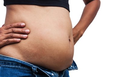 Kadınlar fat belly ve streç işaretleri, ön tarafı
