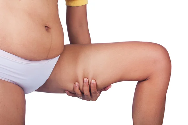 Nők kövér hasa Térkép cellulit-a leg — Stock Fotó