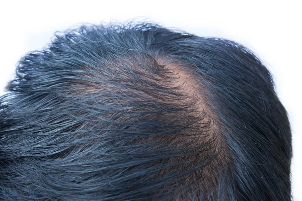 bald head of young man on white background