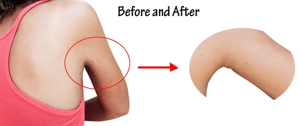 Before and after scratch mark and wrinkle of armpit — Stock Photo, Image