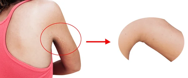 Before and after scratch mark and wrinkle of armpit — Stock Photo, Image