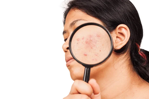 Women show acne on skin with magnifier — Stock Photo, Image