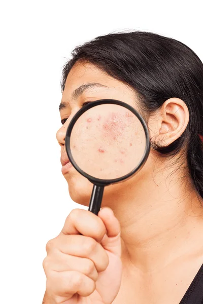 Frauen zeigen Akne auf der Haut mit Lupe — Stockfoto