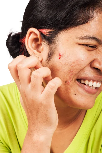 Acne na pele cara de mulheres — Fotografia de Stock