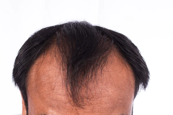 Careca cabeça de jovem no fundo branco — Fotografia de Stock