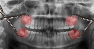 display four wisdom teeth over x-ray clipart