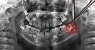 dental scan: wisdom teeth clipart