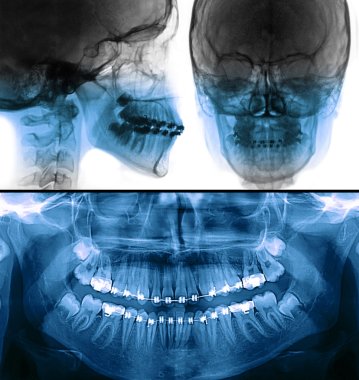 fixed appliance x-ray, orthodontic treatment clipart
