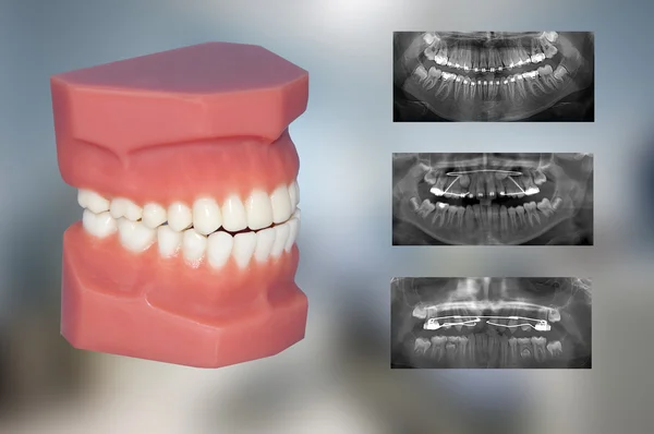 Modelo odontológico: tratamento ortodôntico — Fotografia de Stock