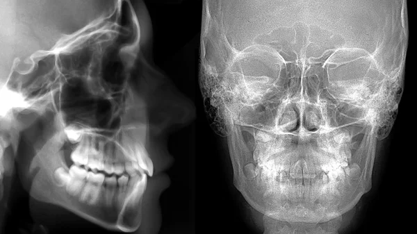 Cephalometric: 전면 및 측면 프로필 — 스톡 사진